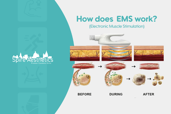 EMS treatment for post pregnancy weight loss treatment Swindon