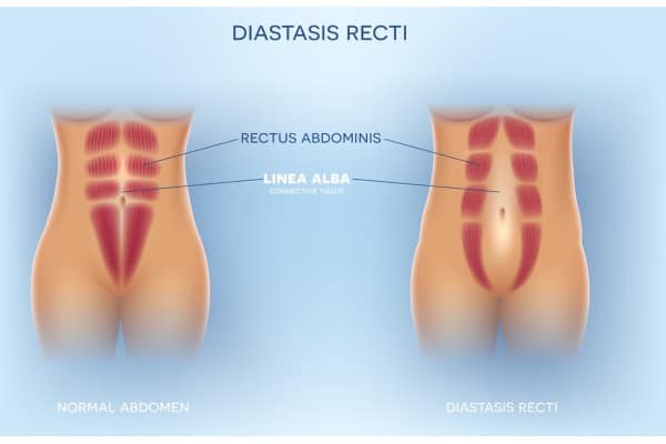What Non-Surgical Options Are Available for Diastasis Recti Swindon?