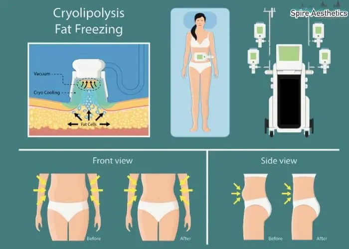 Fat freezing treatment Swindon benefits for competitions to remove stubborn fat deposits.