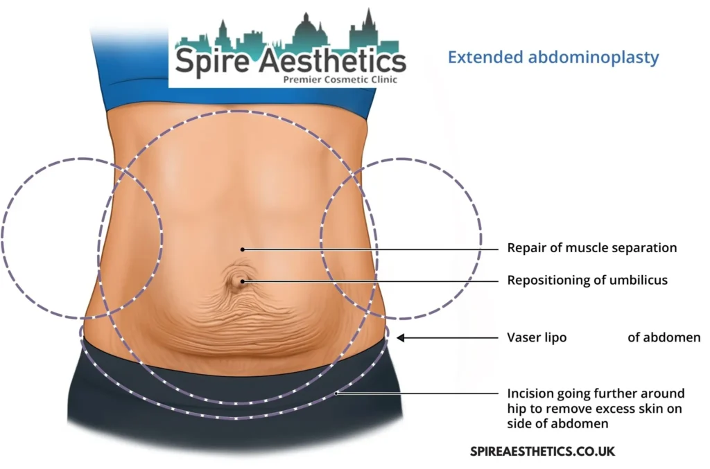 Understanding Loose Skin After Gastric Band Swindon Surgery and HIFU Treatment