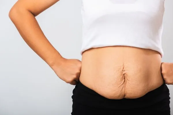 Image of a woman's stomach after weight loss with sagging skin following a gastric band Swindon