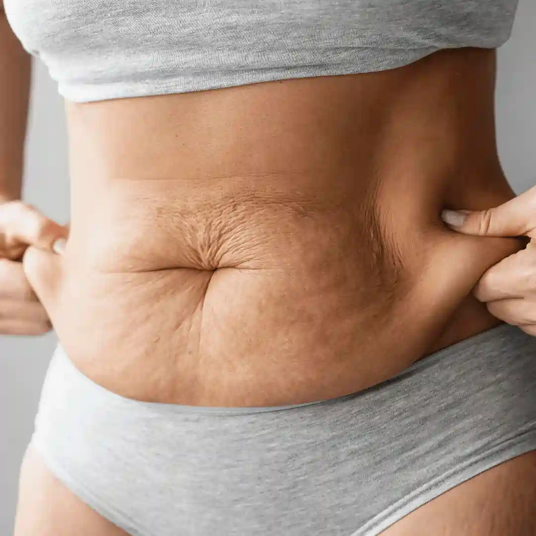 Is It Normal to Have Loose Skin After Pregnancy Swindon?