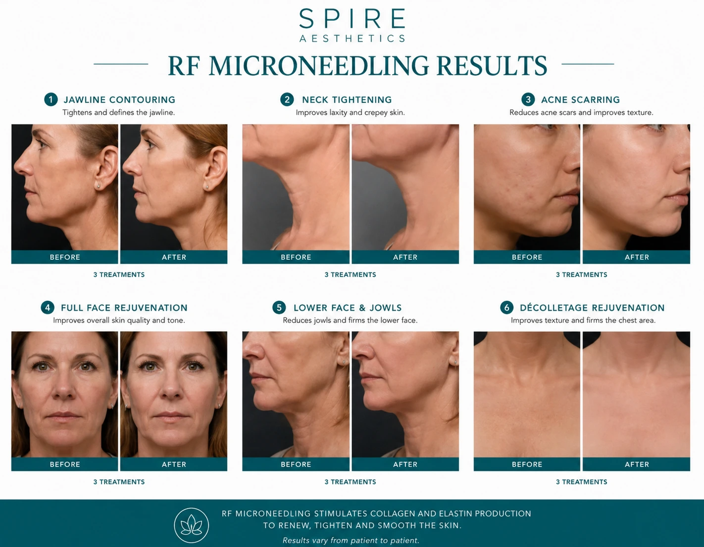 RF Microneedling Skin tightening Swindon results