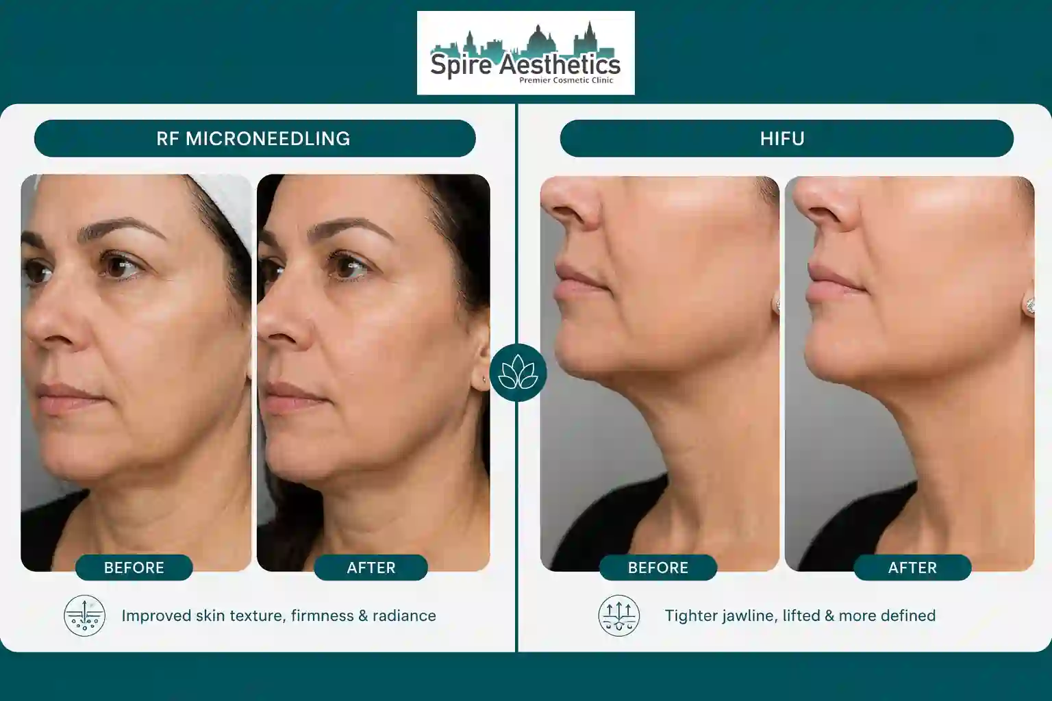 Can RF Microneedling and HIFU Be Combined Swindon?