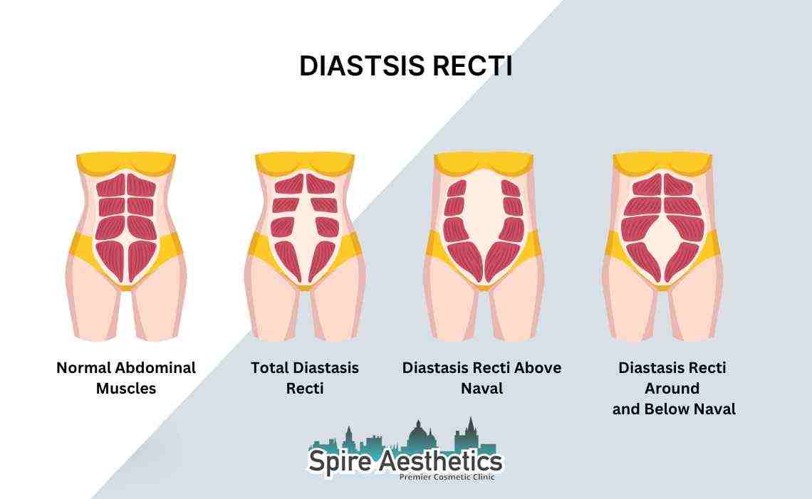 Is Non-Surgical Diastasis Recti Treatment Right for You? Common Concerns Answered Swindon